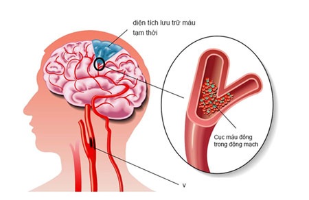 Thiếu máu não - Không nên chủ quan - 1 Xơ vữa động mạch nguyên nhân gây ra thiếu máu não