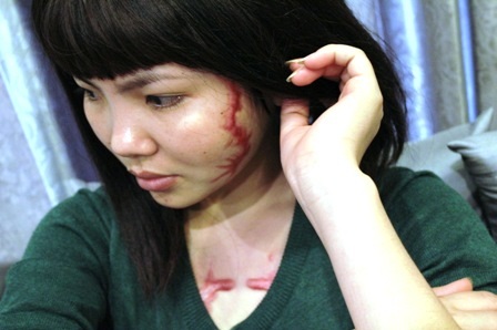 Bài 9: Vụ cô gái bị xăm “quái vật”: “Đa kim ngân phá luật lệ” - 1 Nạn nhận Nguyễn Thị G trở lại Hà Nội khám vết thương