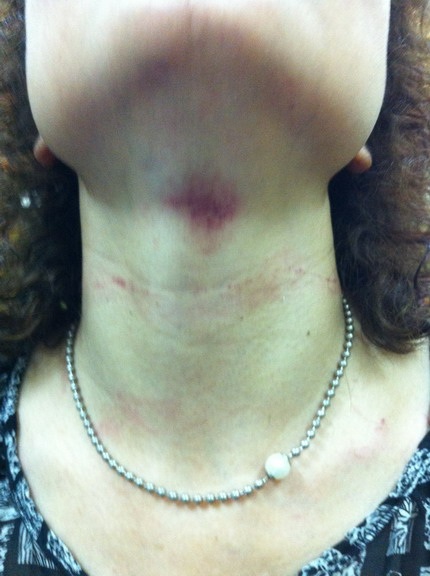 Vết thâm tím do bị hành hung trên cổ bà Hạnh