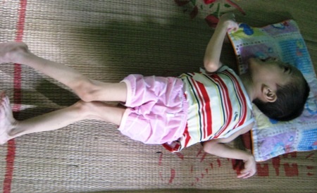 Mang trên mình căn bệnh  bại não bẩm sinh, 8 năm qua bé Đức luôn chịu sự hành hạ về thể xác