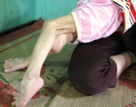 Thấy con quằn quại trong đau đớn nhưng vợ chồng anh Quỳnh cũng lực bất tòng tâm