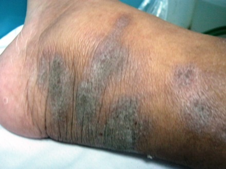 Đôi chân anh Nguyễn bị bầm tím, hoại tử dần