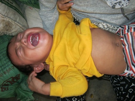 Sự sống mong manh của bé 15 tháng tuổi bị ung thư máu