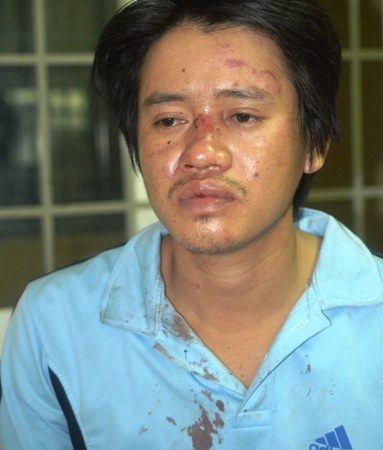 Anh Ái nhập viện điều trị với nhiều vết thương ở vùng mặt, sau gáy và lưng