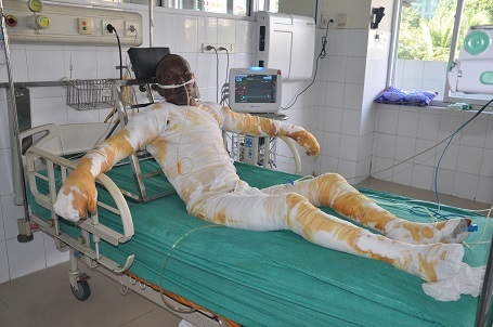 Anh Minh nằm kế phòng bên cạnh với 90% diện tích bỏng, bỏng sâu hô hấp.