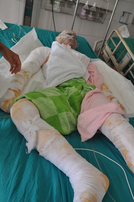 
Mới 16 tuổi, tương lai của em trở nên xám xịt vì ca bỏng do vụ nổ tàu gây ra.
