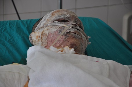 Cháu Dư cũng bỏng đến hơn 30% toàn bộ cơ thể.