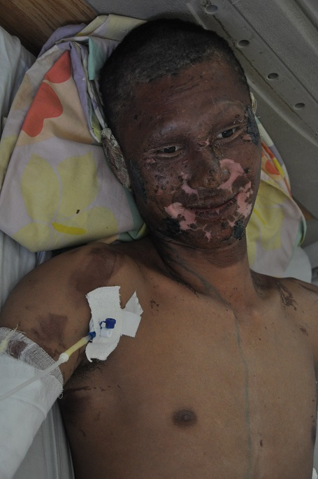 Tất cả mọi người đều bị cháy đen mặt.