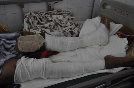 Toàn bộ chân, tay và cơ thể đều bị bỏng nặng.