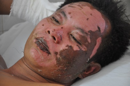 3 anh còn lại hiện đang điều trị tại khoa Bỏng người lớn.