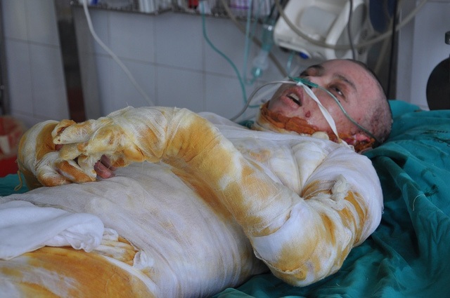 Bị bỏng đến 90% cơ thể trong đó có 60% bỏng sâu, tính mạng cậu bé Ân tưởng chừng sẽ không giữ được.