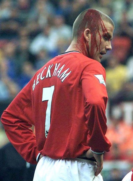 Các các thủ từng bị "máu tuôn xối xả" như C.Ronaldo - 8 Những dòng máu phun trào từ cơ thể các cầu thủ bóng đá