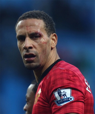 ...khiến cho cầu thủ này chảy máu