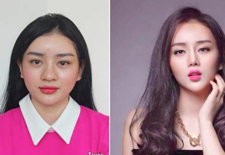 Những ca phẫu thuật thẩm mỹ thành công của Dr.Kim - 4 Những ca phẫu thuật thẩm mỹ thành công của Dr.Kim