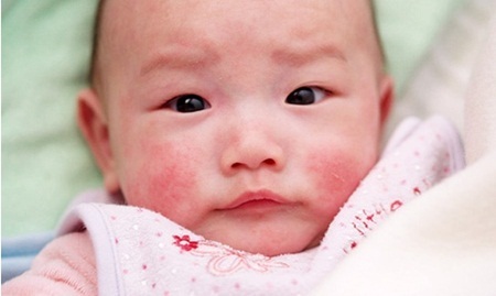 Cách nào phòng các bệnh thường gặp cho trẻ khi giao mùa? - 2 Dị ứng da: