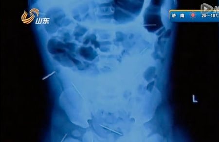 Bé gái 1 tuổi bị cắm cả tá kim vào người - 2 Bé gái 1 tuổi bị cắm 12 chiếc kim vào người