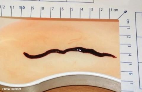 Phát hiện sán 10cm “trú” trong thận - 1 Con sán được lấy ra từ thận của bà Hana
