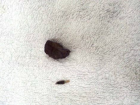 Viên sỏi và nhánh vòng chữ T, thủ phạm gây đau
và tạo sỏi.