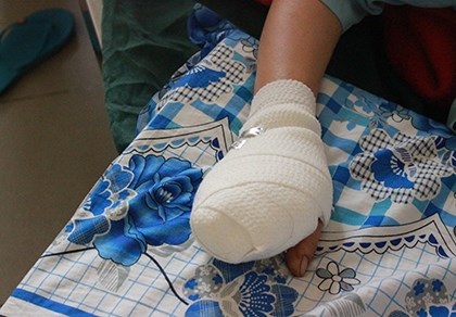 Một phụ nữ bị máy xay thịt nghiền nát bốn ngón tay - 1 Chị N. đang điều trị tại bệnh viện.