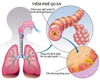 Lưu ý trong chăm sóc trẻ viêm phế quản