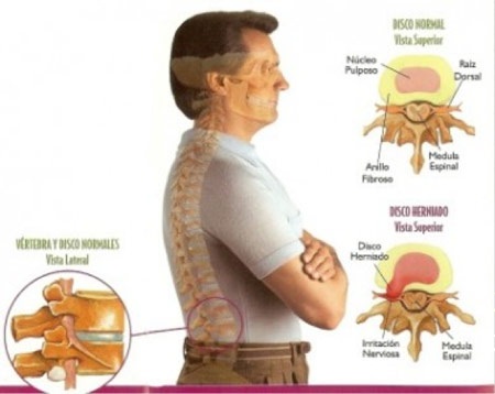Hậu quả bệnh đau lưng
– đau thần kinh tọa