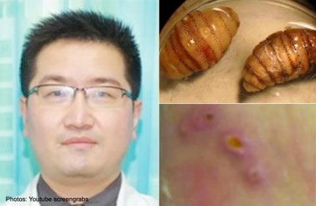 Bệnh nhân và những con giòi lấy ra từ vết loét