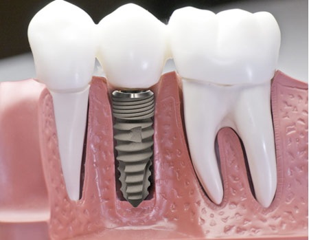 Quy Trình Cắm Ghép Implant An Toàn Tại Nha Khoa Đông Nam - 1 Quy Trình Cắm Ghép Implant An Toàn Tại Nha Khoa Đông Nam