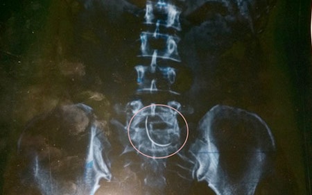 Hình ảnh chiếc
kim khâu cong vút từ phim chụp X-quang của chị Hòa.