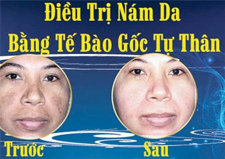 Cải lão hoàn đồng bằng tế bào gốc? - 2 Thả nổi quản
  lý