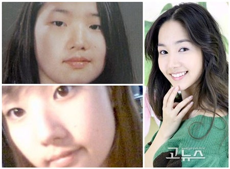 Vân Tokyo tiếp tục thẩm mỹ môi cười tại TTTM Mimi - 8 Ảnh trước và sau của Park Min Young
