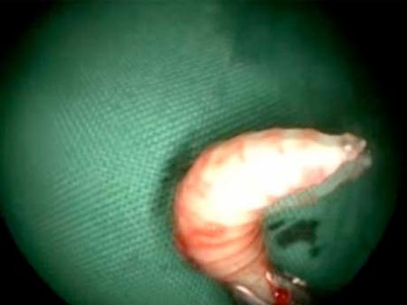 Lấy 50 con dòi khỏi mũi bệnh nhân - 1 Dòi có chiều dài khoảng 1 cm, sống bằng thịt của bệnh nhân
