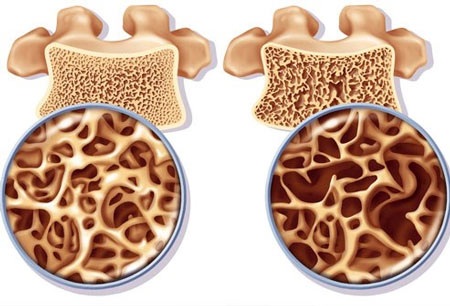 Cẩn thận khi tê mỏi tay chân - 1 Xương khỏe mạnh và xương bị loãng