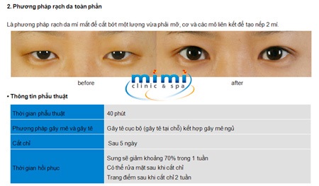 Các kiểu phẫu thuật mắt 2 mí độc quyền của Mimiclinnic - 3 Các kiểu phẫu thuật mắt 2 mí độc quyền của Mimiclinnic