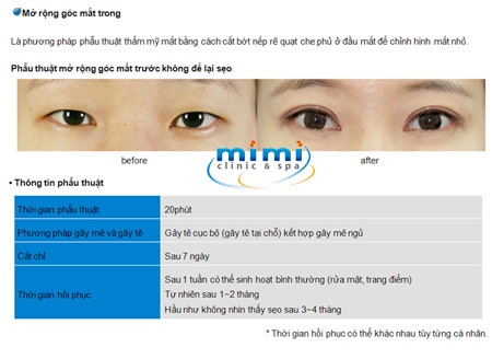 Các kiểu phẫu thuật mắt 2 mí độc quyền của Mimiclinnic - 4 Các kiểu phẫu thuật mắt 2 mí độc quyền của Mimiclinnic