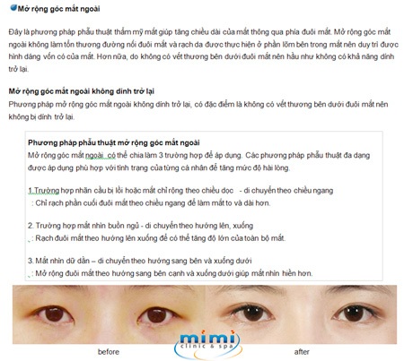 Các kiểu phẫu thuật mắt 2 mí độc quyền của Mimiclinnic - 5 Các kiểu phẫu thuật mắt 2 mí độc quyền của Mimiclinnic