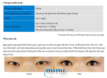 Các kiểu phẫu thuật mắt 2 mí độc quyền của Mimiclinnic - 6 Các kiểu phẫu thuật mắt 2 mí độc quyền của Mimiclinnic