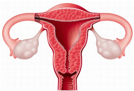 Tổn thương tử cung là biến chứng thường gặp sau sẩy thai, hư
thai