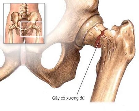 Bệnh loãng xương – đừng nên chủ quan - 1 Gãy cổ xương đùi hay đốt sống do loãng
xương dẫn đến nguy cơ tàn phế và tử vong rất cao