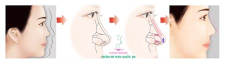Nâng mũi SLine- Xu hướng thẩm mỹ hiện nay - 2 Quy trình tạo mũi Sline