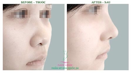 Nâng mũi SLine- Xu hướng thẩm mỹ hiện nay - 3 Dễ dàng nhận thấy
sự khác biệt hoàn toàn trước và sau khi làm mũi Sline