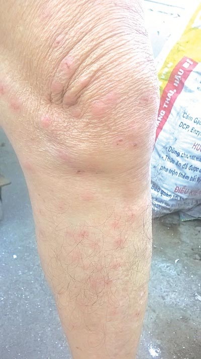 Côn trùng lạ tấn công người dân - 1 Chân của ông Đóa
và tay anh Trung chi chít vết côn trùng cắn