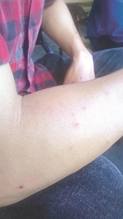 Côn trùng lạ tấn công người dân - 2 Chân của ông Đóa
và tay anh Trung chi chít vết côn trùng cắn
