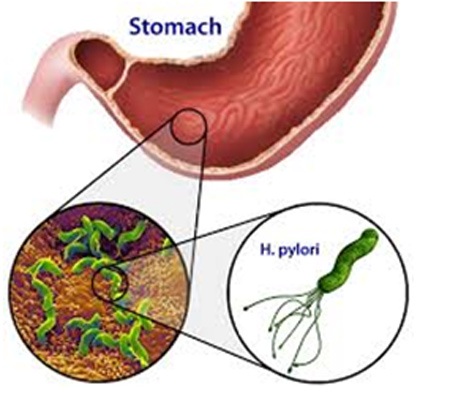 Viêm loét dạ dày có dễ gây ung thư? - 1 Vi khuẩn
Helicobacter pylori gây viêm loét dạ dày