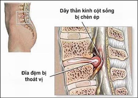 Phát hiện thoát vị đĩa đệm từ chứng đau lưng - 2 Hình ảnh giải phẫu đĩa đệm bị thoát vị