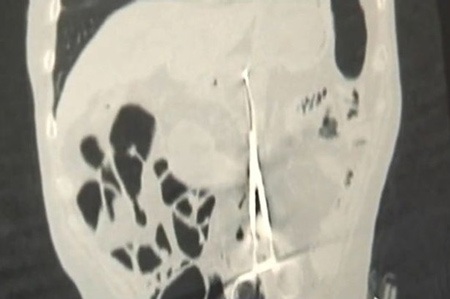 Bỏ quên kéo trong bụng bệnh nhân 12 năm