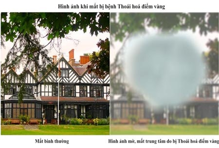 Thoái hóa điểm vàng và triệu chứng 3M của mắt