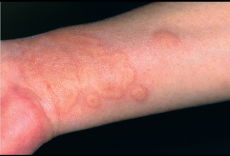 Biểu hiện chứng mề đay do lạnh ở cánh tay.