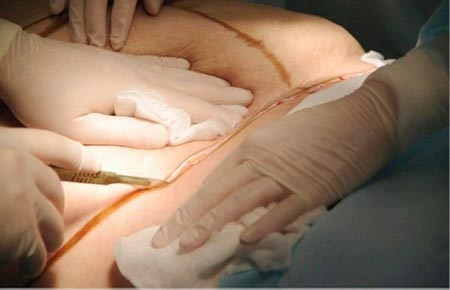 Lựa chọn giảm cân bằng thực phẩm chức năng hay phẫu thuật - 1 Hình minh họa