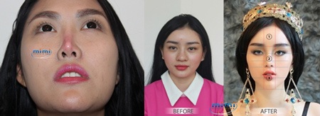 Ekip bác sĩ Hàn Quốc khẩn cấp ra phác đồ xử lý mũi hỏng cho Phi Thanh Vân - 1 Ekip bác sĩ Hàn Quốc khẩn cấp ra phác đồ xử lý mũi hỏng cho Phi Thanh Vân