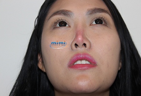 Ekip bác sĩ Hàn Quốc khẩn cấp ra phác đồ xử lý mũi hỏng cho Phi Thanh Vân